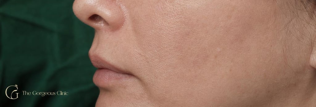 Photorealistic macro image of mature cheek skin texture under soft clinical lighting, shallow depth-of-field, subtle pores and realistic skin tone, forest green cloth in background, editorial medical-aesthetic quality, single focal point