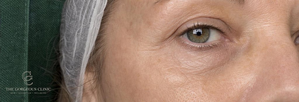 Photorealistic macro image of mature skin texture showing fine crepey lines on the lower eyelid and cheek, clinical soft light, single focal point, natural pores and realistic skin tone, no cosmetics, subtle forest green background textile and sterile gauze visible, editorial medical-aesthetics feel.