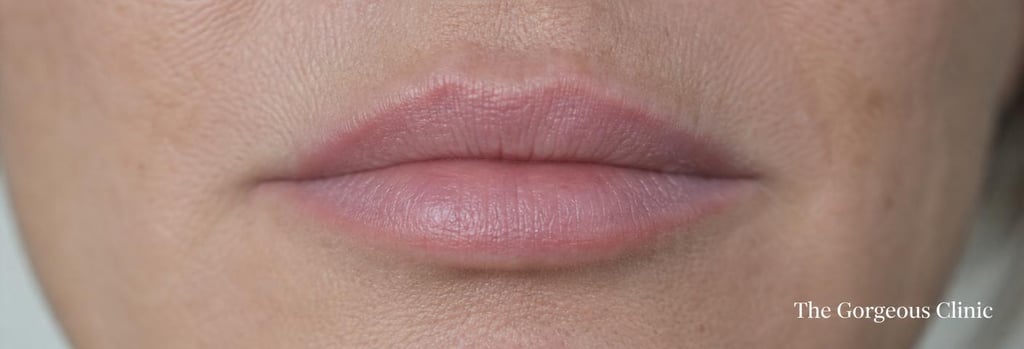 Photorealistic close-up of lips in soft clinical lighting, gentle natural texture, slight blurring around the lip border to illustrate migration, mature skin detail visible, no exaggerated filler, editorial medical feel, shallow depth-of-field, neutral background, tasteful and clinical