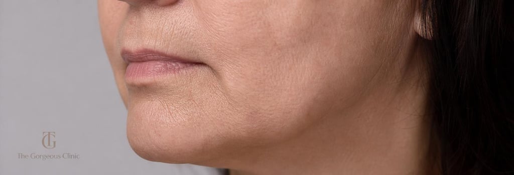 Photorealistic close-up of lower cheek and jawline on a mature face, gentle clinical lighting, visible subtle contour and skin texture, single focal point on jawline, editorial-quality medical-aesthetic image.