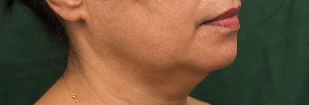 Photorealistic macro image of mature skin texture showing subtle swelling near the jawline, soft clinical lighting, forest green cloth in background, editorial feel, no logos