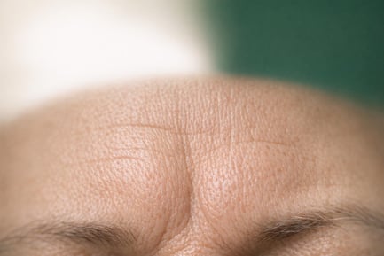 Frown Lines Treatment | Anti-Wrinkle Injections Blackpool